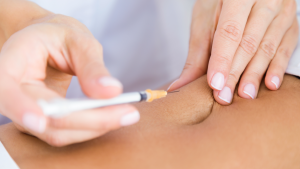 Liposuzione completa Roma