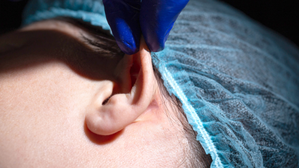 Otoplastica in tutta Torino