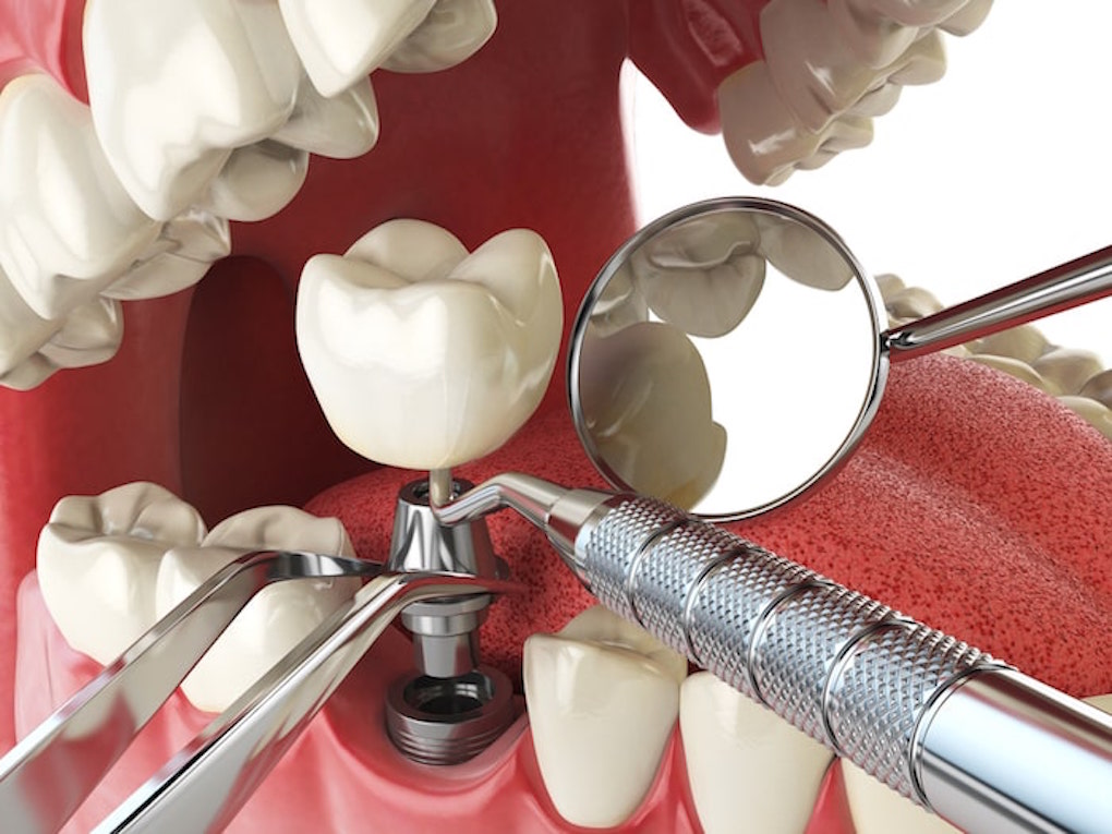 Listino Prezzi per impianto dentale Milano